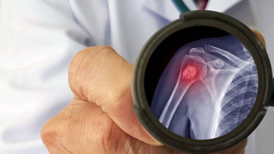 bone cancer