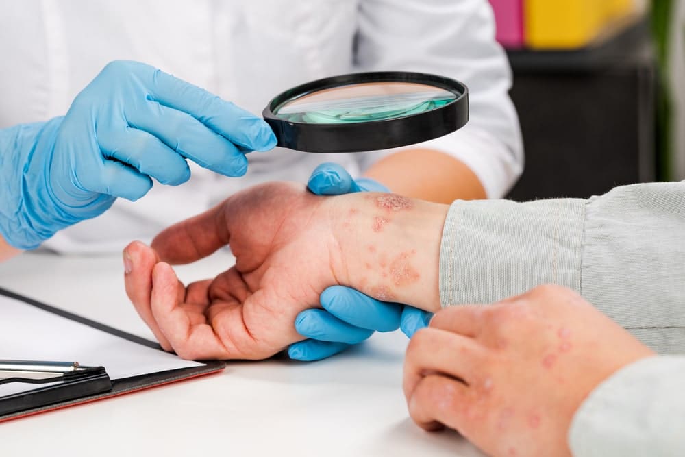 psoriasis