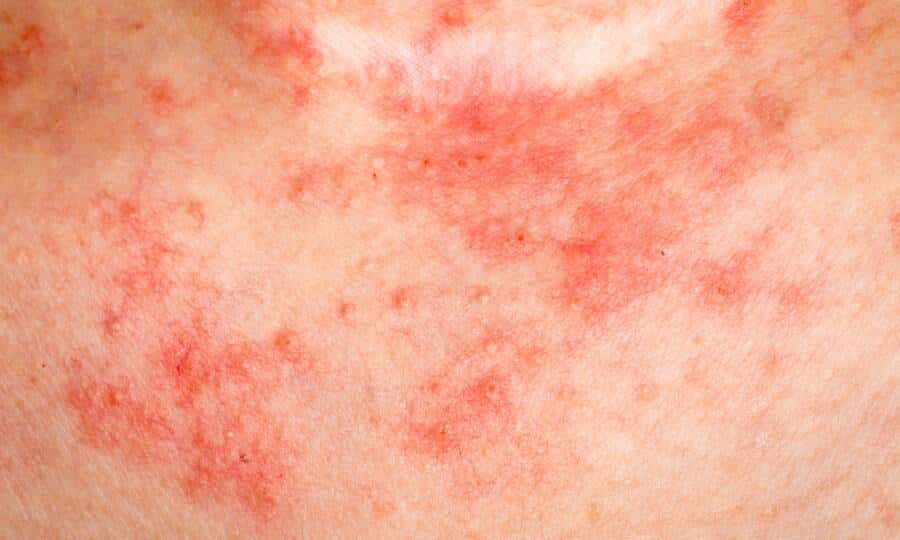 skin conditions
