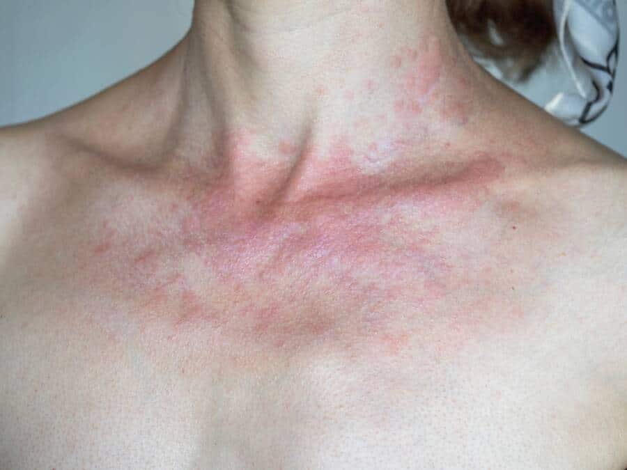 sun allergy