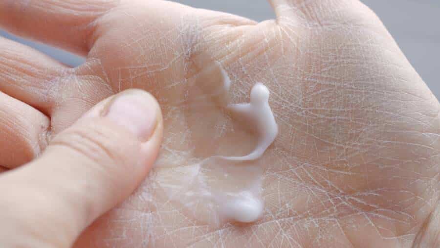 psoriasis triggers
