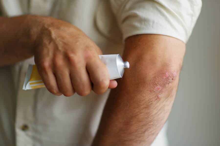 psoriasis triggers