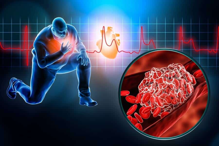 Chest Pain vs. Blood Clots