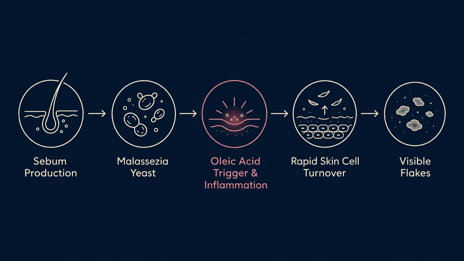 A minimalist horizontal diagram detailing the biological cycle from sebum production and Malassezia yeast to inflammation and flakes.
