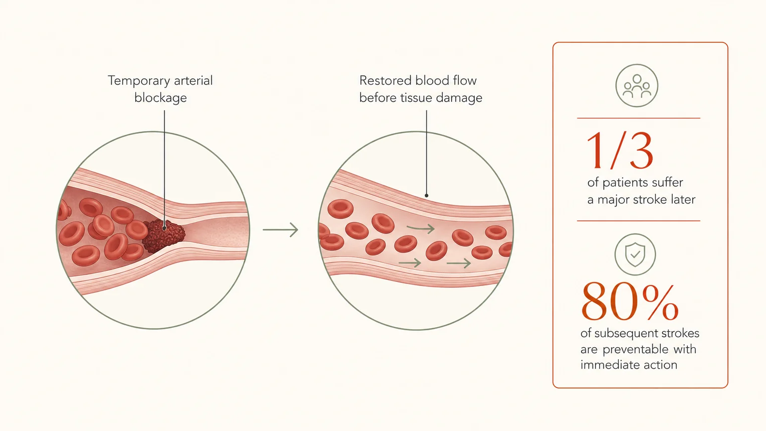 A minimalist medical diagram showing a temporary arterial blockage resolving, alongside statistics on stroke prevention rates.