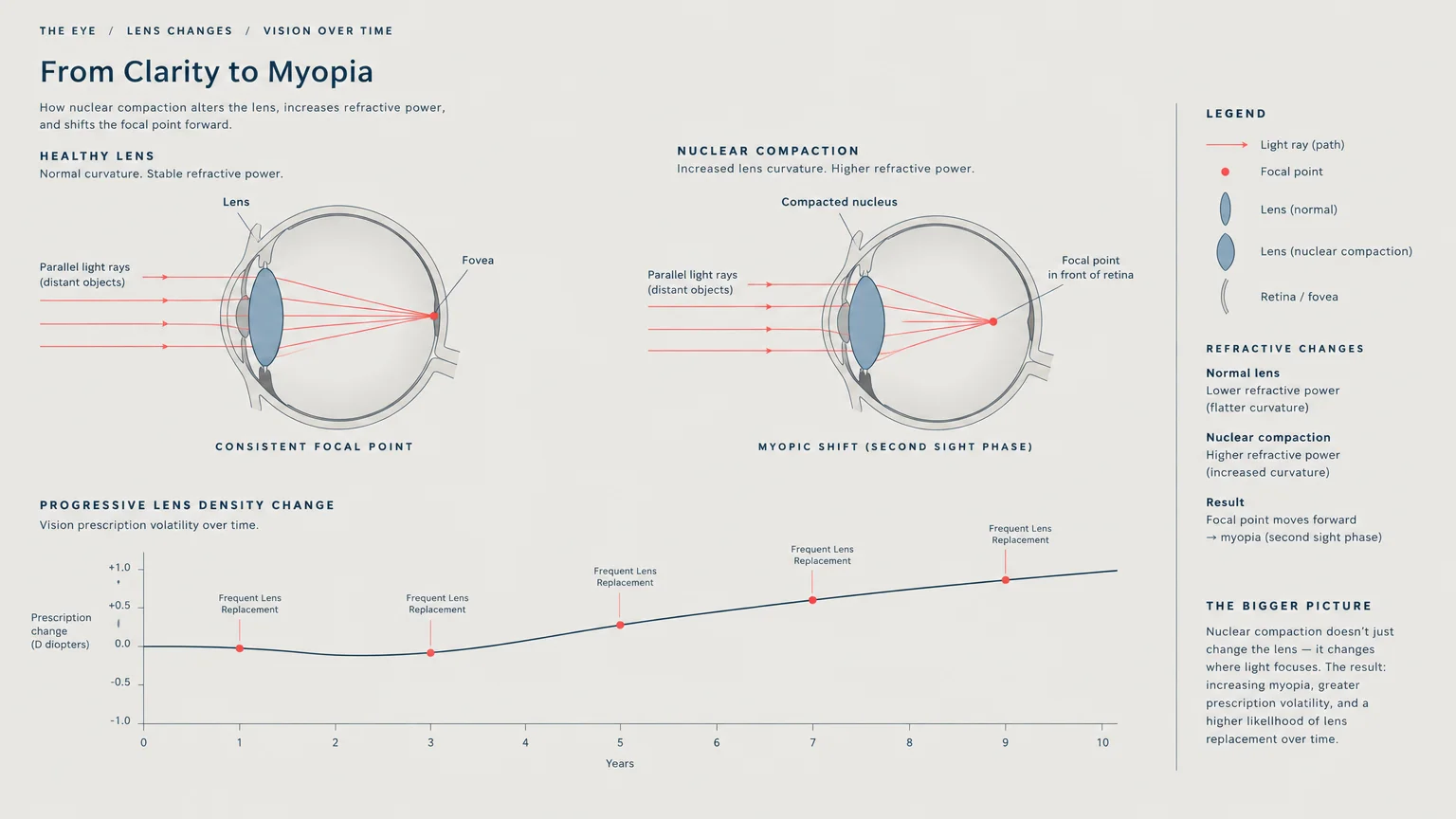 Diagram comparing light focus in a healthy eye versus compacted lens, alongside a graph of prescription changes over time.