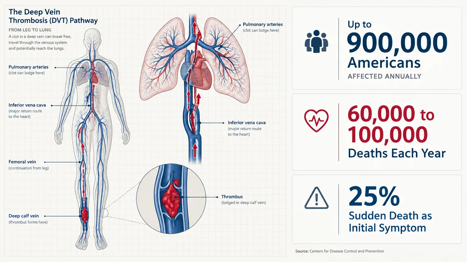 Medical diagram tracing a blood clot from the leg to the lungs alongside annual CDC statistics on DVT cases and deaths.