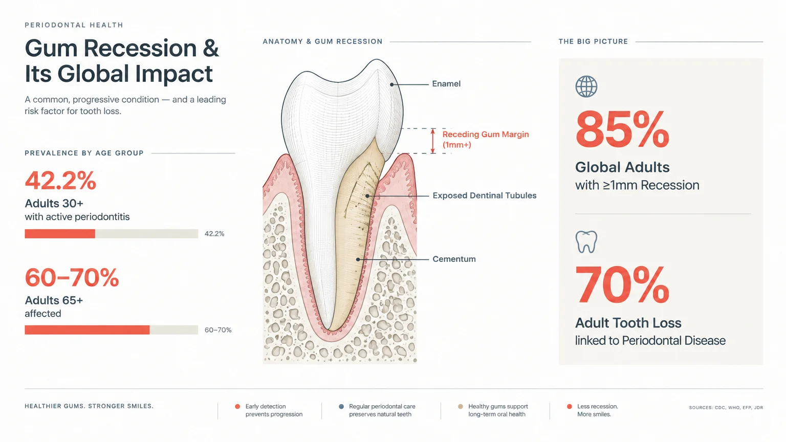 Diagram of tooth anatomy highlighting receding gum margin and exposed dentin, flanked by periodontal disease statistics.