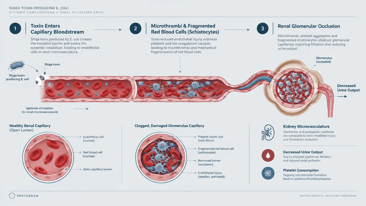 Medical diagram showing Shiga toxins causing microthrombi and renal glomerular occlusion, leading to decreased urine output.